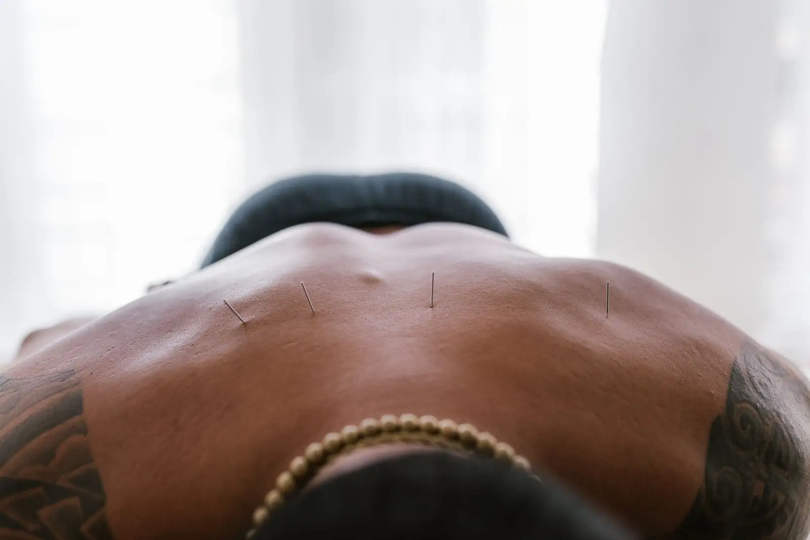 Séance d'acupuncture en cabinet : fines aiguilles posées sur le dos d'une patiente allongée